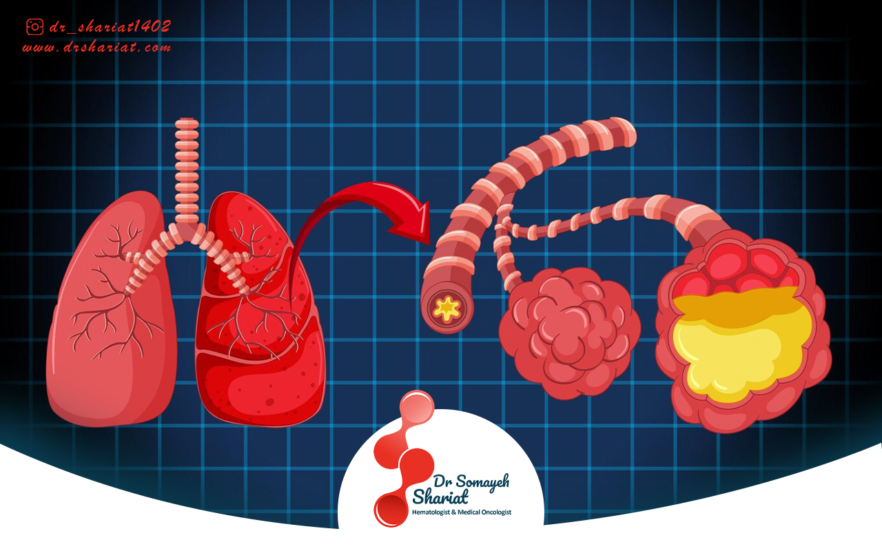 ورزش منظم و تاثیر آن بر پیشگیری از سرطان مری