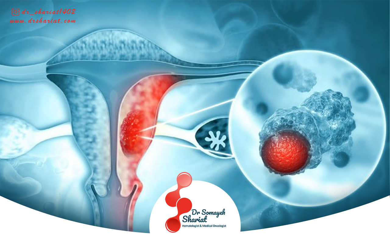 شیمی درمانی و پرتودرمانی برای سرطان رحم