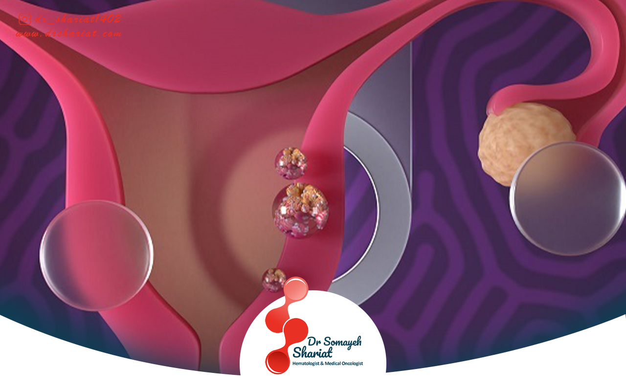 تشخیص زود هنگام و گزینههای درمان سرطان رحم