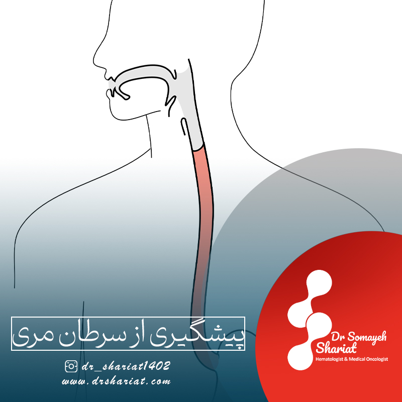 پیشگیری از سرطان مری