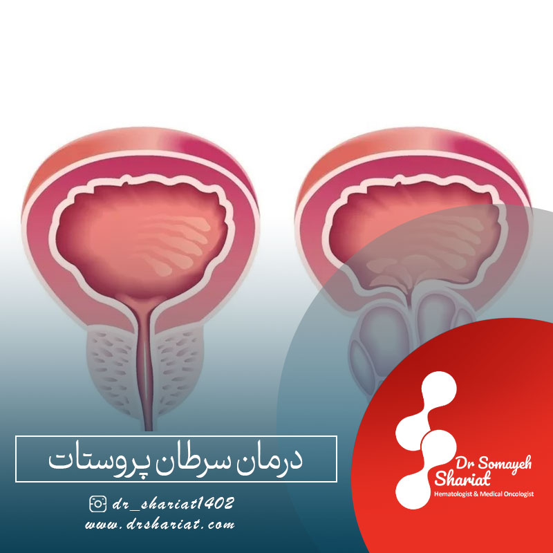 درمان سرطان پروستات