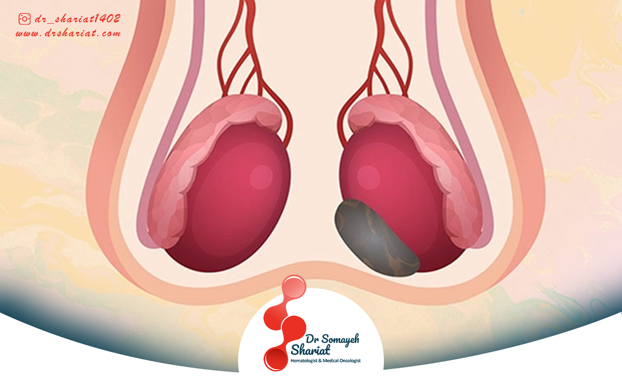 شیمی درمانی و پرتو درمانی برای سرطان بیضه