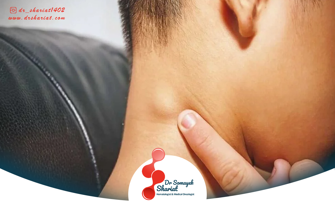 روش های درمان لنفوم هوچکین
