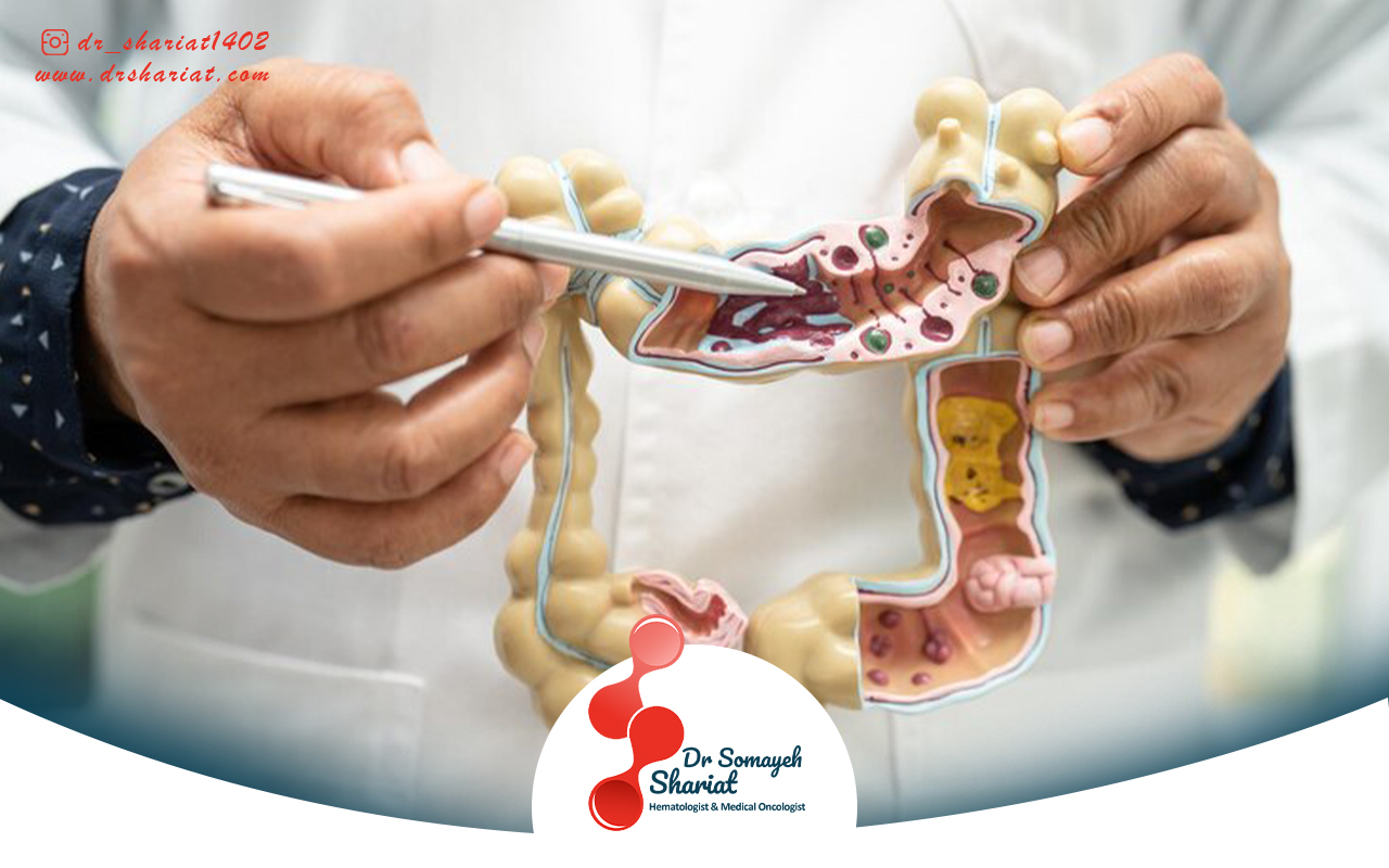 روش های درمان سرطان رکتوم